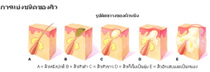 ชนิดของสิวอุดตัน