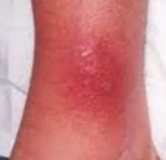 🌈เซลล์เนื้อเยื่ออักเสบ(Cellulitis)