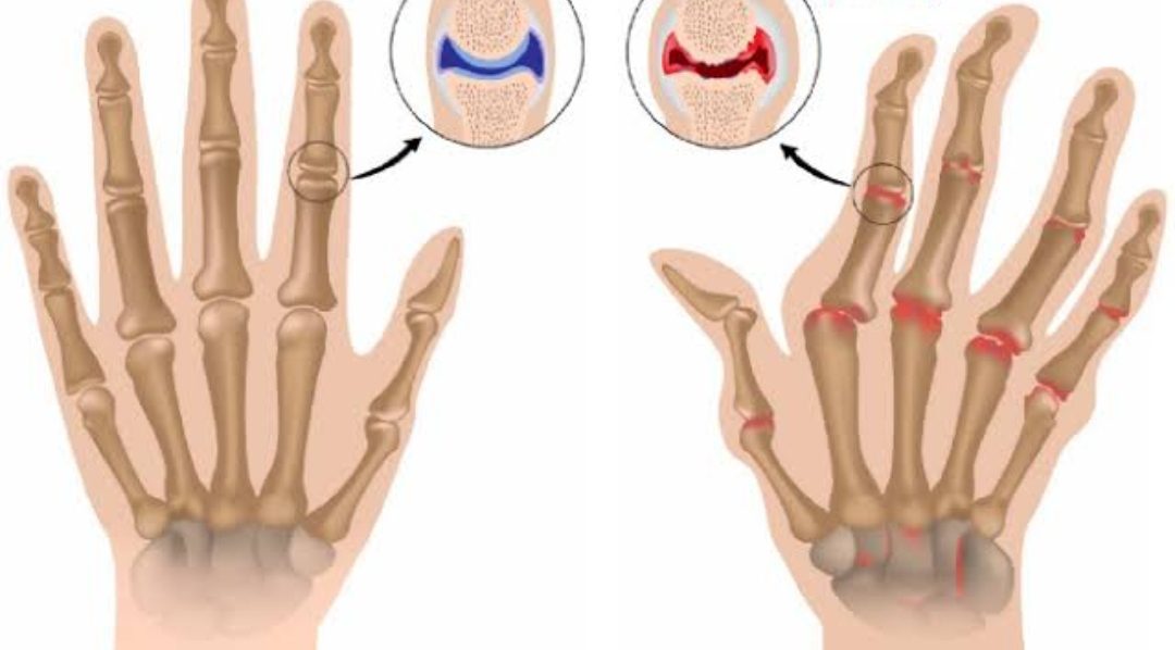 ✅️โรคข้ออักเสบรูมาตอยด์ RHeuMaToiD ArThriTis