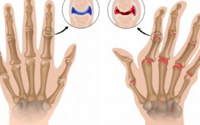 ✅️โรคข้ออักเสบรูมาตอยด์ RHeuMaToiD ArThriTis