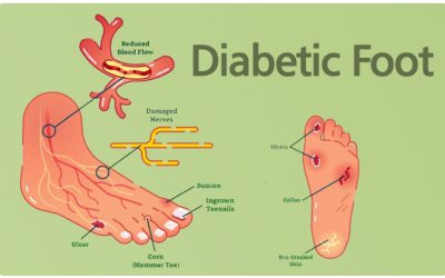 🌈แผลเบาหวานเท้า ติดเชื้อ อักเสบ DM FooT CelluLiTis