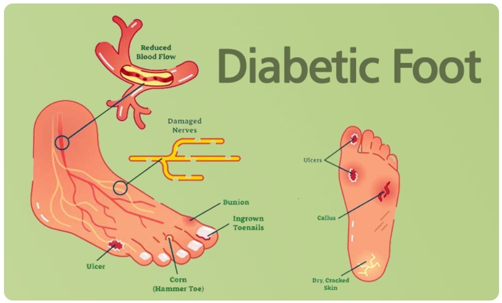 🌈แผลเบาหวานเท้า ติดเชื้อ อักเสบ DM FooT CelluLiTis