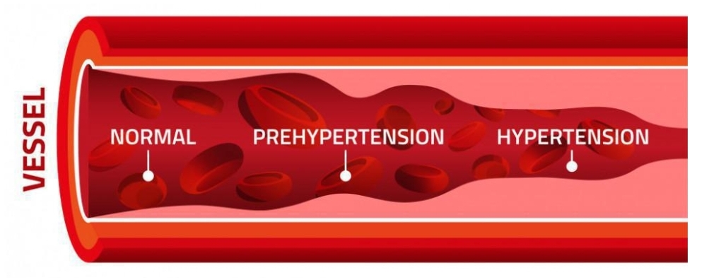 🌈ความดันโลหิตสูง HyPertension