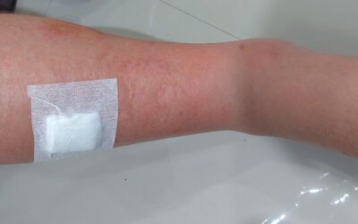 เซลล์เนื้อเยื่ออักเสบ  หรือ “Cellulitis” (เซลลูไลติส)