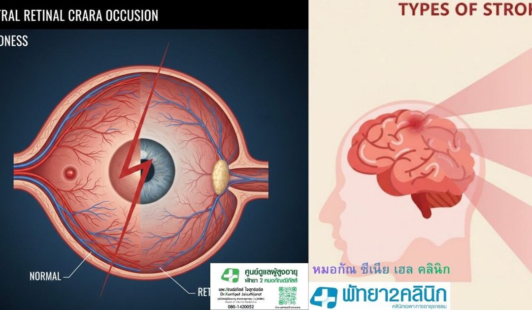 หลอดเลือดสมอง
