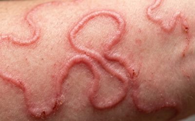 ​ผื่นเส้นนูน คัน ย้ายที่ได้! รู้จัก “โรคพยาธิไชผิวหนัง” (Larva Migrans) และเคสจริงจากคนไข้