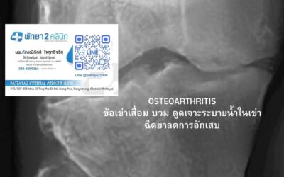 ข้อเข่าเสื่อมและภาวะน้ำในข้อเข่า: กรณีศึกษาการเจาะระบายน้ำและฉีดยาลดอักเสบ โดย นพ. กัณฒิภัสส์