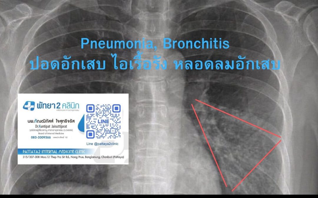 ไอเรื้อรัง ปอดอักเสบ
