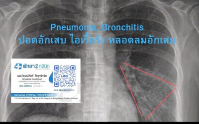 ปอดอักเสบในผู้สูงอายุ ที่มีประวัติสูบบุหรี่เรื้อรัง รู้ทันอาการก่อนสาย