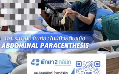 ตับแข็ง ไม่ได้เกิดจากเหล้าเพียงอย่างเดียว: รู้ทันสาเหตุ อาการท้องมาน และการรักษาโดยแพทย์เฉพาะทาง