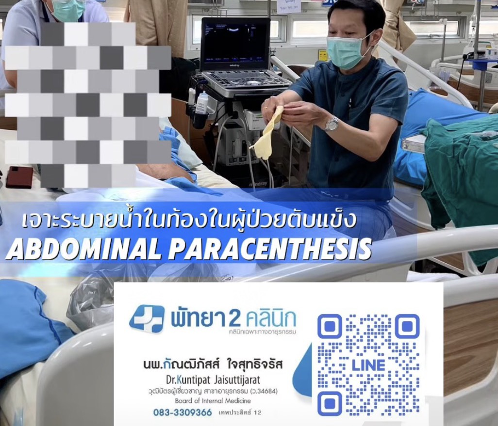 ตับแข็ง ไวรัสตับอักเสบบี ซี เอ