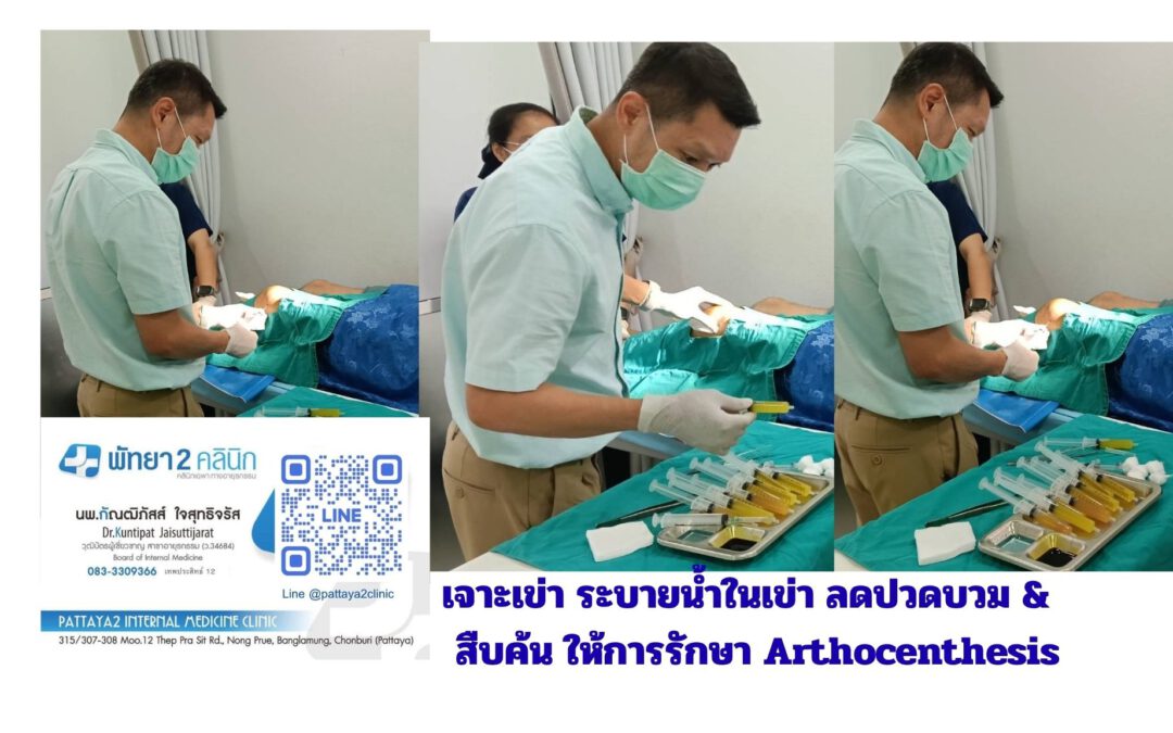 เจาะระบายน้ำในเข่า arthocenthesis หมอกัณฒิภัสส์